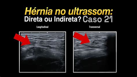 hernia inguinal direta ultrassom